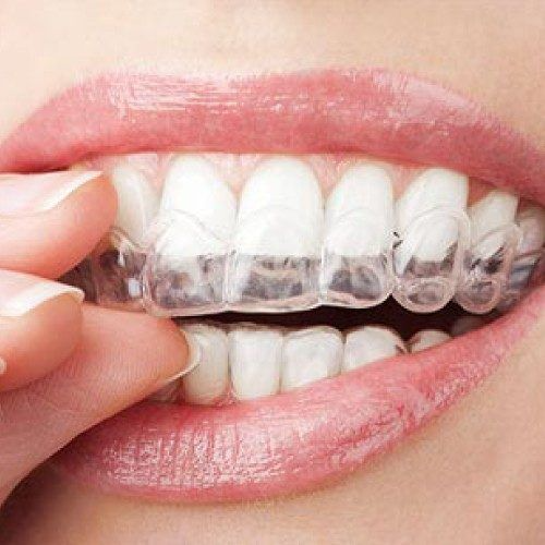 Weighing The Pros And Cons Before Getting Invisalign