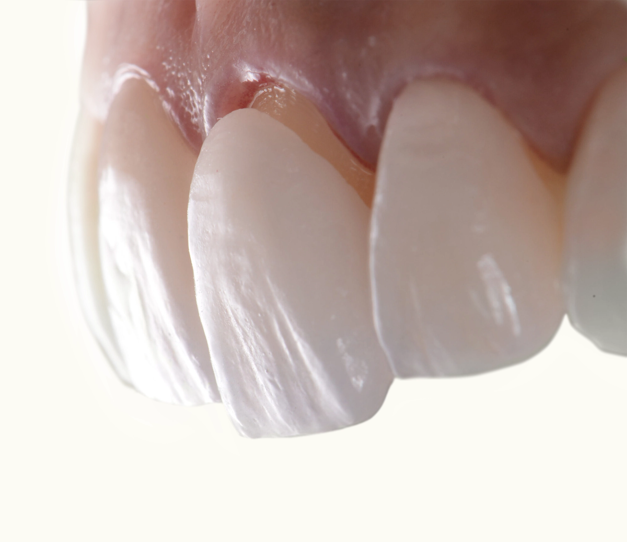 The Advantages of Dental Veneers